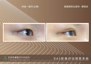 雙眼皮姊妹案例_DAS_1-2