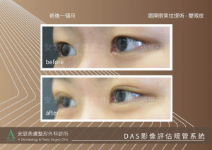 雙眼皮姊妹案例_DAS_1-4