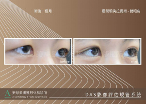 雙眼皮姊妹案例_DAS_2-2