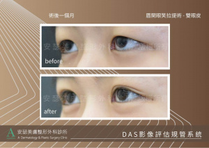 雙眼皮姊妹案例_DAS_2-4